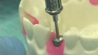 Placing Implant Abutments [upl. by Aliuqat]