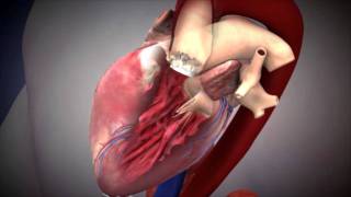 NUHCS  Transcatheter Aortic Valve Implantation TAVI [upl. by Nerine814]