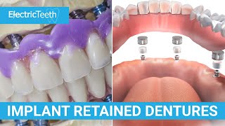 Implant retained dentures explained [upl. by Dez]