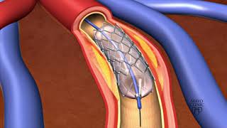 External Iliac Artery Stenting [upl. by Ezequiel336]