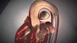 Fluoroscopy and Animation of the TAVI Procedure  NEJM [upl. by Yseulte123]