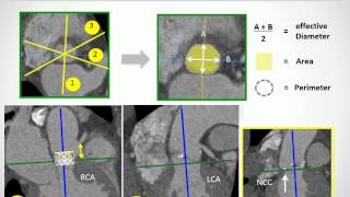 Patient selection for TAVI patient risk profile amp anatomical selection criteria [upl. by Meggs]