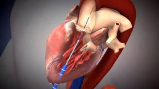 SAPIEN TAVR Deployment Using Transapical Approach [upl. by Grane]