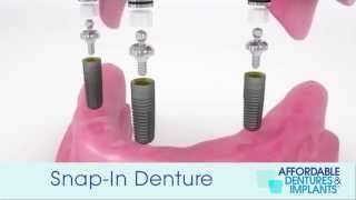 Demo How Do SnapIn Dentures With Implants Work [upl. by Yarw27]